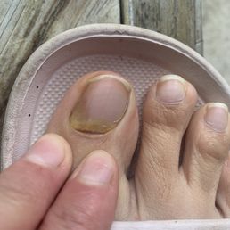 Toe fungus after removing nail polish from the pedicure I received. My nail bed even began to separate. Toe fungus after removing nail polish from the pedicure I received. My nail bed even began to separate.