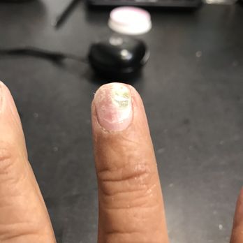 American Nail Spa - Instead of taking off my cracked nail, he just glued it and continued! DO NOT LET ANYONE DO THAT! This is the result!! - Nail Salons Near Me - Elk Grove, California American Nail Spa - Instead of taking off my cracked nail, he just glued it and continued! DO NOT LET ANYONE DO THAT! This is the result!! - Nail Salons Near Me - Elk Grove, California