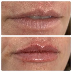 Vanity Aesthetics Lounge - Lip filler by Kim Knight APRN