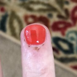 This is 1 week after I had my nails done and "fixed". Still healing and you can see the area that was supposed to be "fixed" still uneven.