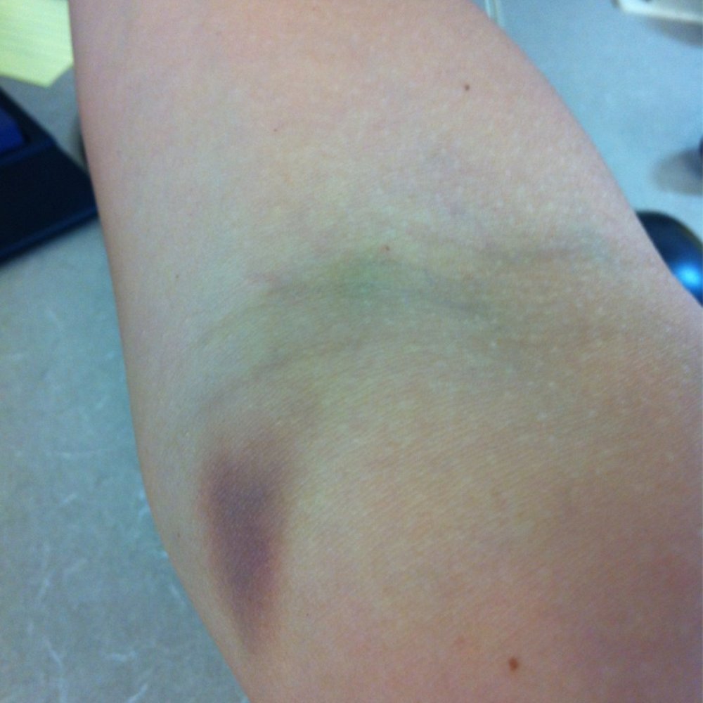 Labcorp - Giant bruise from girl who jabbed me - Laboratory Testing Near Me - San Jose, California