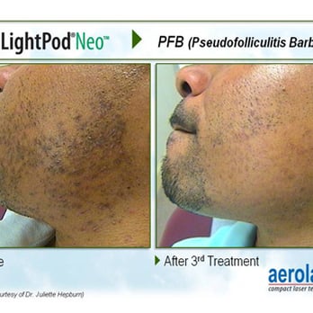 Laser Hair Removal Ingrown Hair Removal Yelp