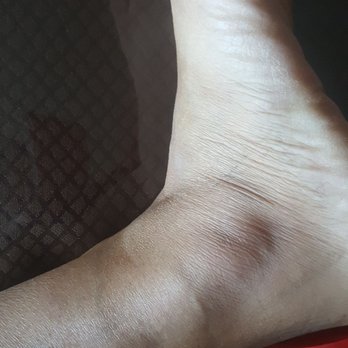 Behmardi Kalantari Chiropractic - little swelling getting better I just removed the tape - Chiropractors Near Me - Rancho Cordova, California Behmardi Kalantari Chiropractic - little swelling getting better I just removed the tape - Chiropractors Near Me - Rancho Cordova, California