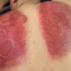 No Limits Cupping - $40 Cupping Massage