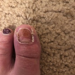 New toenail growing out. Take my advice and STAY AWAY.