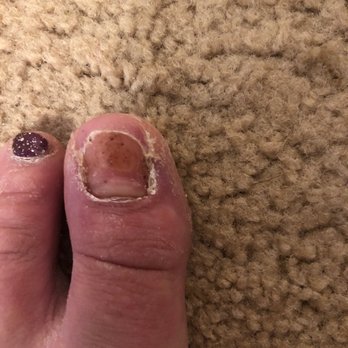 Regal Nails, Salon & Spa - New toenail growing out. Take my advice and STAY AWAY. - Nail Salons Near Me - Fredericksburg, Virginia