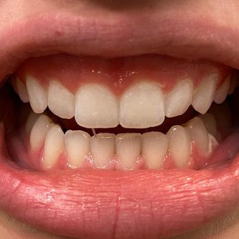 DaVinci Blanch teeth whiting  - Teeth Whitening Near Me - Highlands Ranch, Colorado