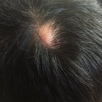 NV Hair Studios - At first the spot was small got infected and doubled in size! - Hair Salons Near Me - Moreno Valley, California