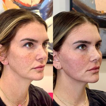 Injector Belle - Mid and lower facelift with threads and jawline filler. - Medical Spas Near Me - Scottsdale, Arizona