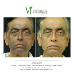 Divine Indulgence Day Spa - VI Peel on Malasma/Hyperpigmentation