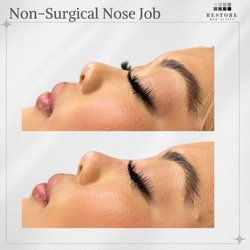 Non-Surgical Nose Filler