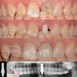 CeraRoot Zirconia Implants - Holistic Dentistry - The central incisor was in bad condition. The patient didn't want metal titanium implant. We're able to do this with no trauma to the gum.
