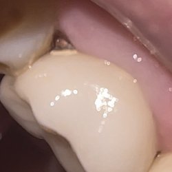 South Texas Endodontics - Decay