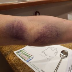 Urgent Care Medical Center - Posting for my fiance.. He went back for more blood work to get his potassium checked and this is what happened.. think they punctured vein