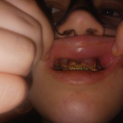 BZG Oral And Maxillofacial Surgery Center - Gum line stitches. Unnecessary cutting. Wrong place.