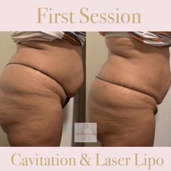 Lush Babe Body Spa - First Tummy Session of Cavitation and Laser Lipo