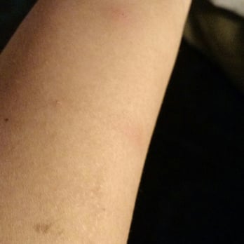Hampton Inn Rehoboth Beach - Bed bug bites - Hotels Near Me - Rehoboth Beach, Delaware Hampton Inn Rehoboth Beach - Bed bug bites - Hotels Near Me - Rehoboth Beach, Delaware