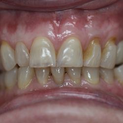 Dental Care of Oceanside - Before cosmetic anterior crowns treatment