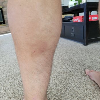 Aa Relaxing Station - Bruises from massage - Massage Near Me - Ojai, California Aa Relaxing Station - Bruises from massage - Massage Near Me - Ojai, California