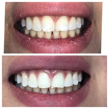 Desert Dentist - The before and after with Composite Fillings and a permanent retainer  after the Invisalign treatment. - Cosmetic Dentists Near Me - Hesperia, California