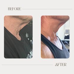 OC Body Clinic - Radio frequency facial results