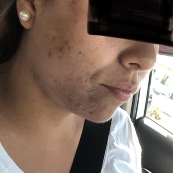 Gerard Nat, MD - In the process ... but their where still break outs - Dermatologists Near Me - Downey, California Gerard Nat, MD - In the process ... but their where still break outs - Dermatologists Near Me - Downey, California