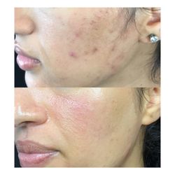 Victoria Kartseva - Ritual - Acne Treatments