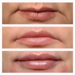 Ideal Image Nashville - Before, 1 syringe of Juvederm, then second syringe of Juvederm one month later - Lips & marionette lines.