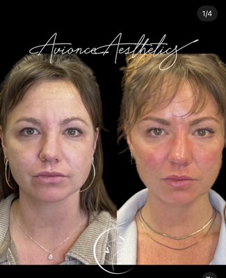Lip & Dermal Fillers - Whether you are looking to enhance your cheeks, chin, lips or temples, dermal fillers can help achieve the perfect facial balancing.
Book your consultation today!