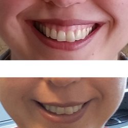 Med-Aesthetic - My Gummy Smile - Before and After of one-session- injection