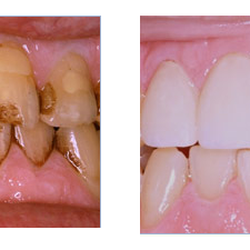 Anne B Filler, DMD, MAGD - Patient's teeth were breaking down & had excessive stain due to smoking. Lower teeth were whitened and 4 all ceramic crowns w...
