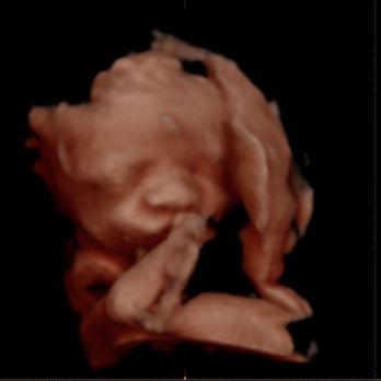Imaging Baby - Ultrasound Imaging Centers Near Me - Castle Rock, Colorado