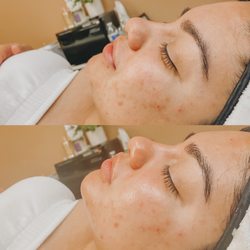 The HydroGlow Facial