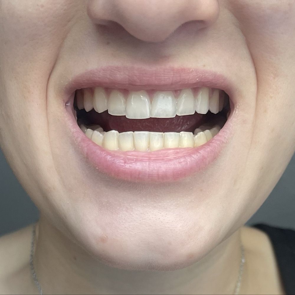 Aida Sahakian, DDS - After with chipped tooth fixed - General Dentistry Near Me - North Hollywood, California