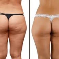 Ultimate Body Spa - Body Toning and Sculpting