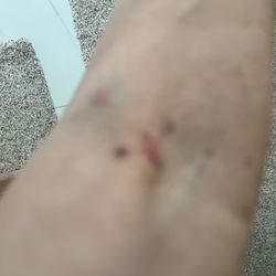 Arm with 3 needles for blood test. 2 no good.