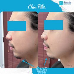 Skintastic Med Spa - Before & After of chin/profile augmentation with filler