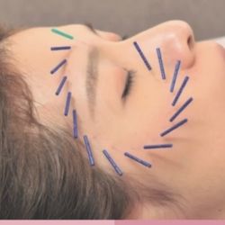 Faith TCM Acupuncture & Cupping - Face and Body wellness