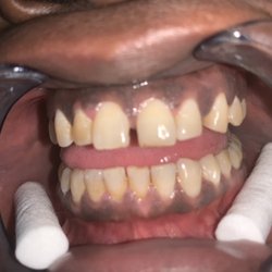 Glowing Smiles Teeth Whitening - Before advance whitening