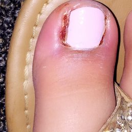 This is my toe after 2 days!!!
