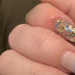 Hole in my finger from the woman drilling into it