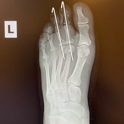 Katy Foot & Ankle, PLLC: Nicolas Manriquez, DPM, FACFAS - Xrays of pins