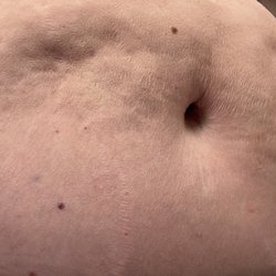 Newvue Plastic Surgery - Post Lipo 360 lower body lift results, he says the dips and ripple are my fault 
