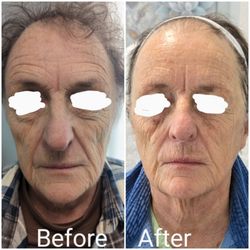 Lee Beauty Med Spa - Facial tightens and lifts, decreases fine lines and wrinkles