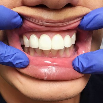 Avant Dental - After - Orthodontists Near Me - Garland, Texas