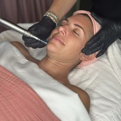 Fresh Face Studio - Micro needling added on to an anti-aging facial