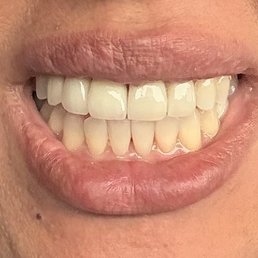 After- The top four teeth have crowns now! After- The top four teeth have crowns now!