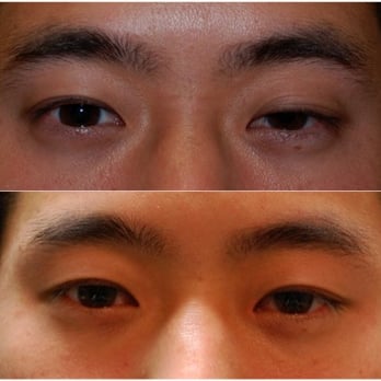 Edward Lee, MD - left upper eyelid ptosis repair - Ophthalmologists Near Me - Los Angeles, California Edward Lee, MD - left upper eyelid ptosis repair - Ophthalmologists Near Me - Los Angeles, California