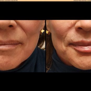 Clarity Medical Spa - These lips are just freshly done so there is swelling and some needle marks - in 3-5 days time they will look fantastic - Medical Spas Near Me - Yreka, California Clarity Medical Spa - These lips are just freshly done so there is swelling and some needle marks - in 3-5 days time they will look fantastic - Medical Spas Near Me - Yreka, California