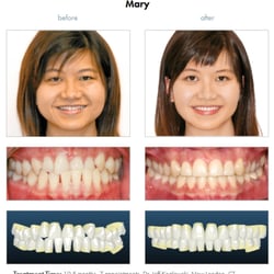 Kozlowski De Pascale Orthodontics - Mary was treated using Insignia 3-D technology and custom fit Damon Brackets. Her total treatment time was 10.5 months.